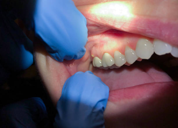 Best Emergency Denture Repair in Paoli, IN